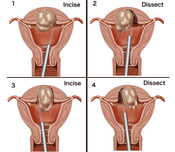 Hysteroscopic Myomectomy