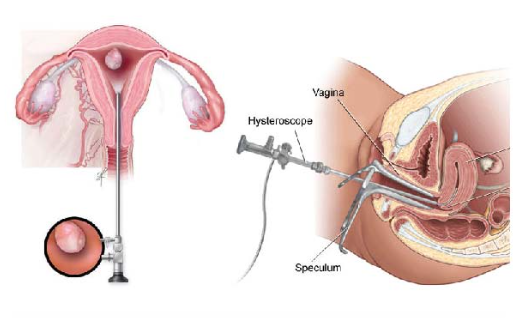 Hysteroscopic Septal Resection