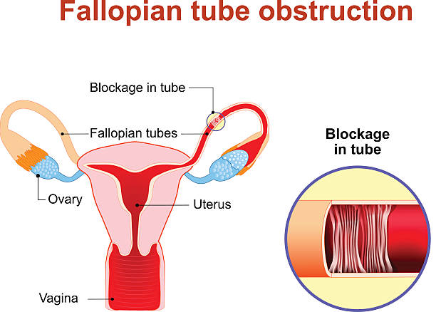 Tubal Cannulation