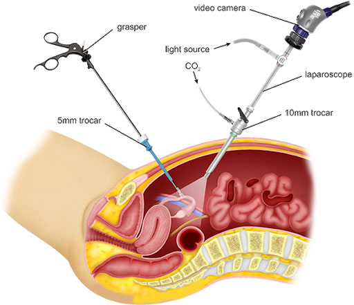 About the Treatment and Dr. Usha’s Expertise in Total Laparoscopic Hysterectomy