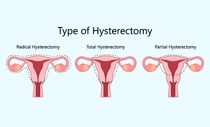 Types of Total Laparoscopic Hysterectomy We Provide