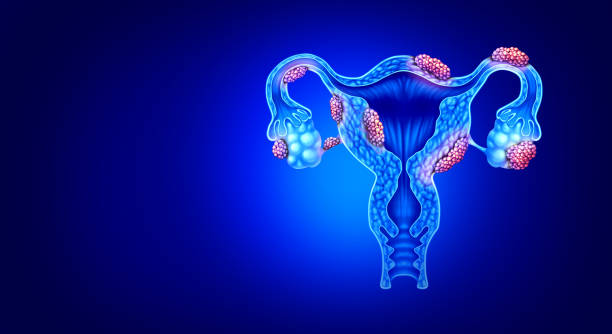  Understanding the Different Types of Endometriosis